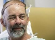 В США впервые в мире проведена пересадка черепа