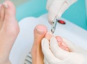 Вросший ноготь: методы профилактики