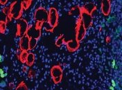 Ученые смогли остановить распространение опухоли