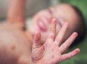 Заболеваемость корью в Украине продолжает расти