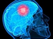 Названы главные факторы риска опухолей мозга