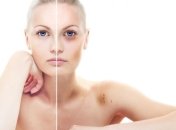 20 практических советов, как быстро убрать синяк