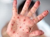 Данные ВОЗ: Украина заняла первое место по количеству больных корью в Европе