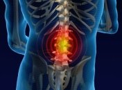 Защемление нерва. Лечение домашними средствами