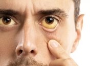 Желтизна на глазах свидетельствует о заболевании печени