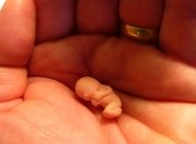 17-недельному зародышу удалили опухоль