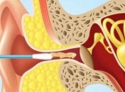 Врачи рассказали, почему нельзя чистить уши ватными палочками