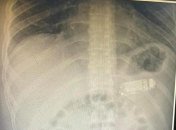 Мужчина проглотил Nokia 3310