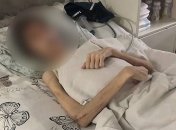 Одессит постом "лечил" сына от бесов: подросток весил 30 килограммов при росте в 180 см