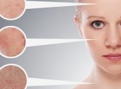 Как избавиться от шрамов и рубцов от прыщей: простые варианты