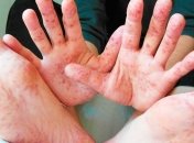 С начала года от кори умерло семеро человек 