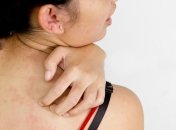 Как справиться с крапивницей в домашних условиях