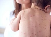 Особливо небезпечною ця хвороба може бути для дітей та вагітних