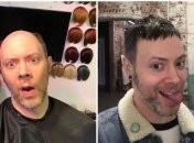 До і після: чоловіки, які позбулися лисини (Фото)