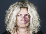 Портреты людей с родимыми пятнами, заставляющие увидеть человека, а не его родинки (Фото) 