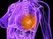 Ученые выяснили, что провоцирует рак груди