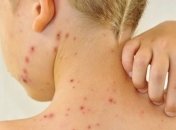 Україна ввійшла у трійку країн Європи, де найбільше хворіють на кір