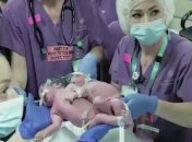 В Израиле провели уникальную операцию по разделению годовалых близнецов