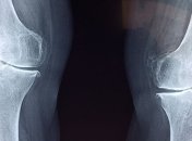 Разработан гидрогель, который обладает такими же свойства, как человеческий хрящ (Фото)