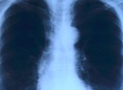 Небезвредные лучи: названа опасность рентгена