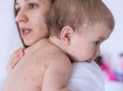 Сколько людей заболели корью в Украине с начала года