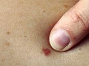 Почему появляются красные родинки на теле