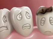 Ученые назвали самую главную причину кариеса