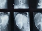 Вредная привычка чуть не довела 11-летнюю девочку до язвы: фото, что достали из ее желудка