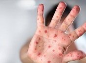 В Украине уменьшилось случаев заболеваний корью