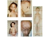 Прогерия - самое загадочное заболевание в мире