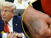 Дональд Трамп прикрывает синяк