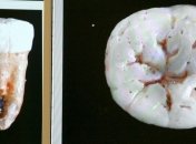 Стрессы могут испортить зубы