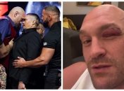 Тайсон Фьюри показал последствия своей травмы