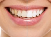 Как отбелить зубы в домашних условиях