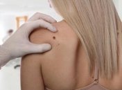 Какие родинки на теле человека считаются опасными? 