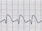 Стресс на работе повышает риск возникновения инфаркта на 23%