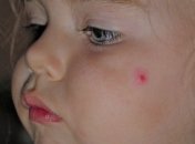 Пивные дрожжи эффективны против прыщей