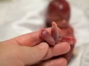 История малыша, который родился на 19 неделе беременности (ФОТО)