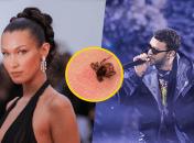 Белла Хадид и Джастин Тимберлейк борются с болезнью Лайма