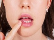 Как легко избавиться от герпеса на губах