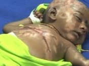 Индийский младенец страдает от самовоспламенения