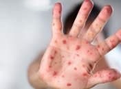 Игнорирование вакцинации против кори в Украине привело к вспышкам заболевания