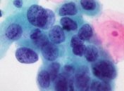 Ученые разработали тест для диагностики рака кожи