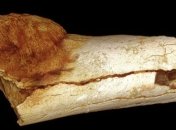 Найден старейший образец рака в кости раннего человека 