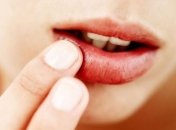 Практические советы по борьбе с герпесом 
