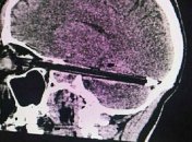 В Ростове из мозга мужчины вытащили ручку (фото)