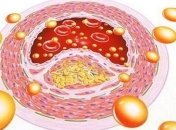 Врачи назвали главные симптомы забитых артерий