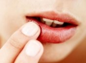 Как предотвратить появление герпеса на губах?