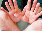 В МОЗ призвали к проведению мероприятий с преодоления вспышки кори