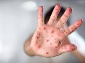 На Львовщине зарегистрировали корь